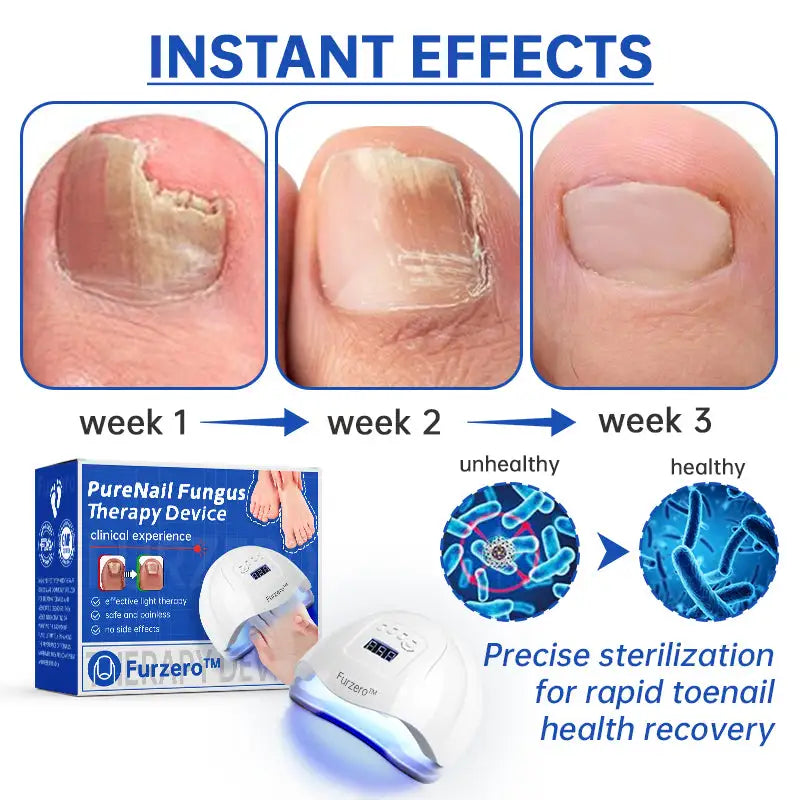 Fungus Laser Therapy Device - Mirelle