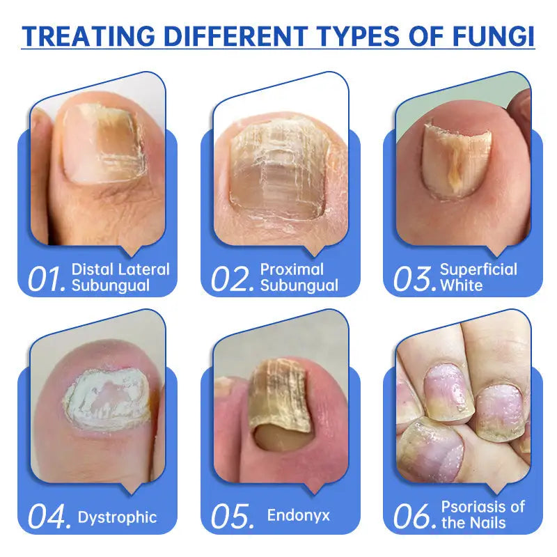 Fungus Laser Therapy Device - Mirelle