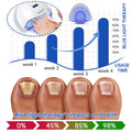 Fungus Laser Therapy Device - Mirelle